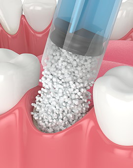 bone grafting