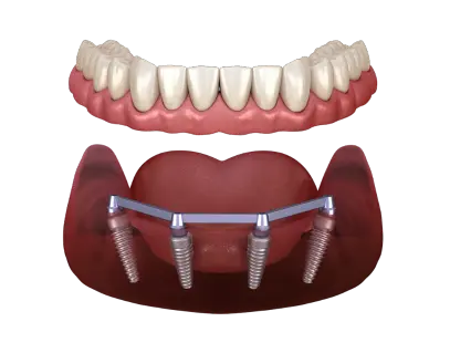 All-on-4 Dental Implants