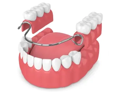 Partial Dentures