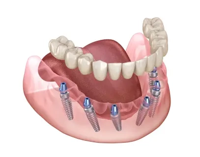 All-on-6 Dental Implants