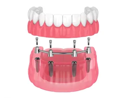 Denture Stabilization 1