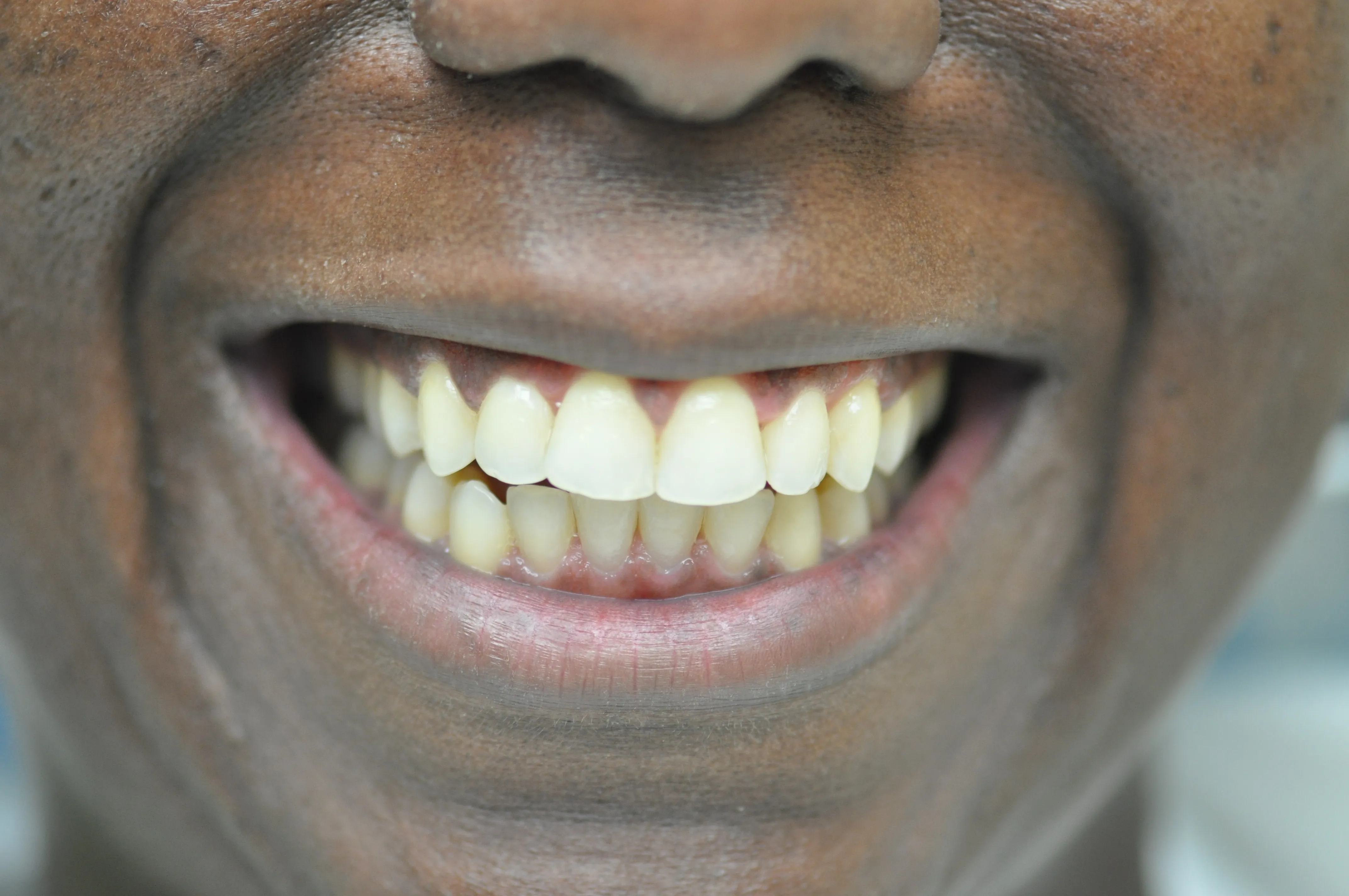 Esthetic Crown Lengthening After​