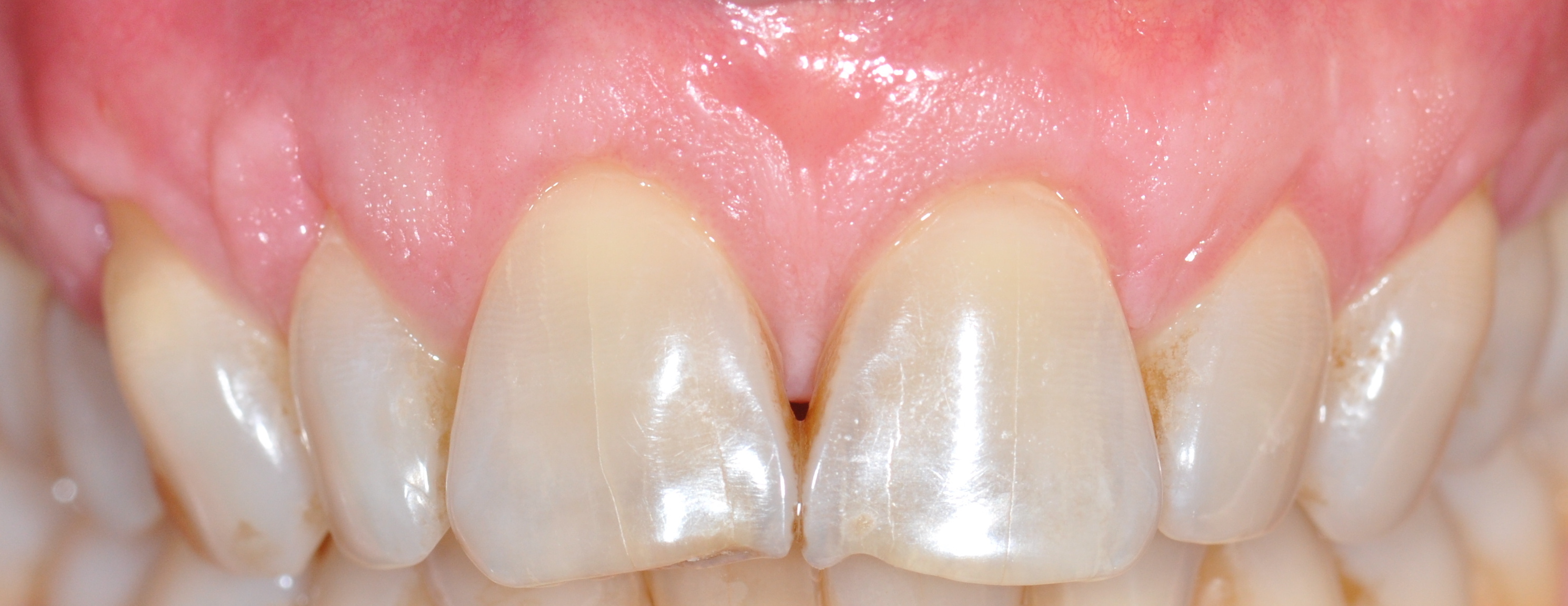 Esthetic Recession Grafting After