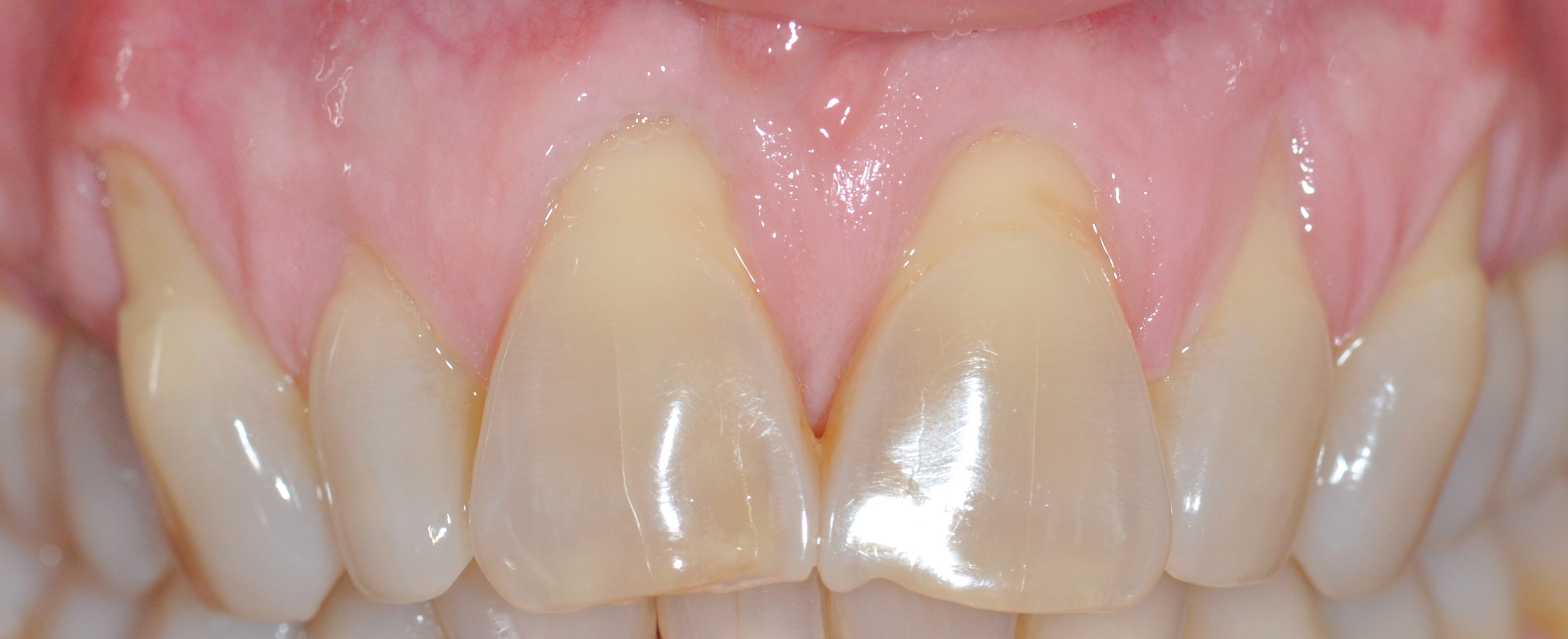 Esthetic Recession Grafting Before