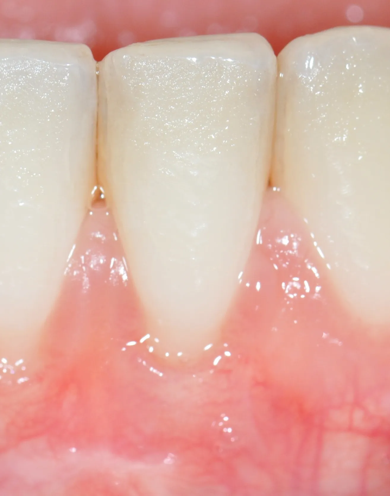 Root Coverage Grafting After