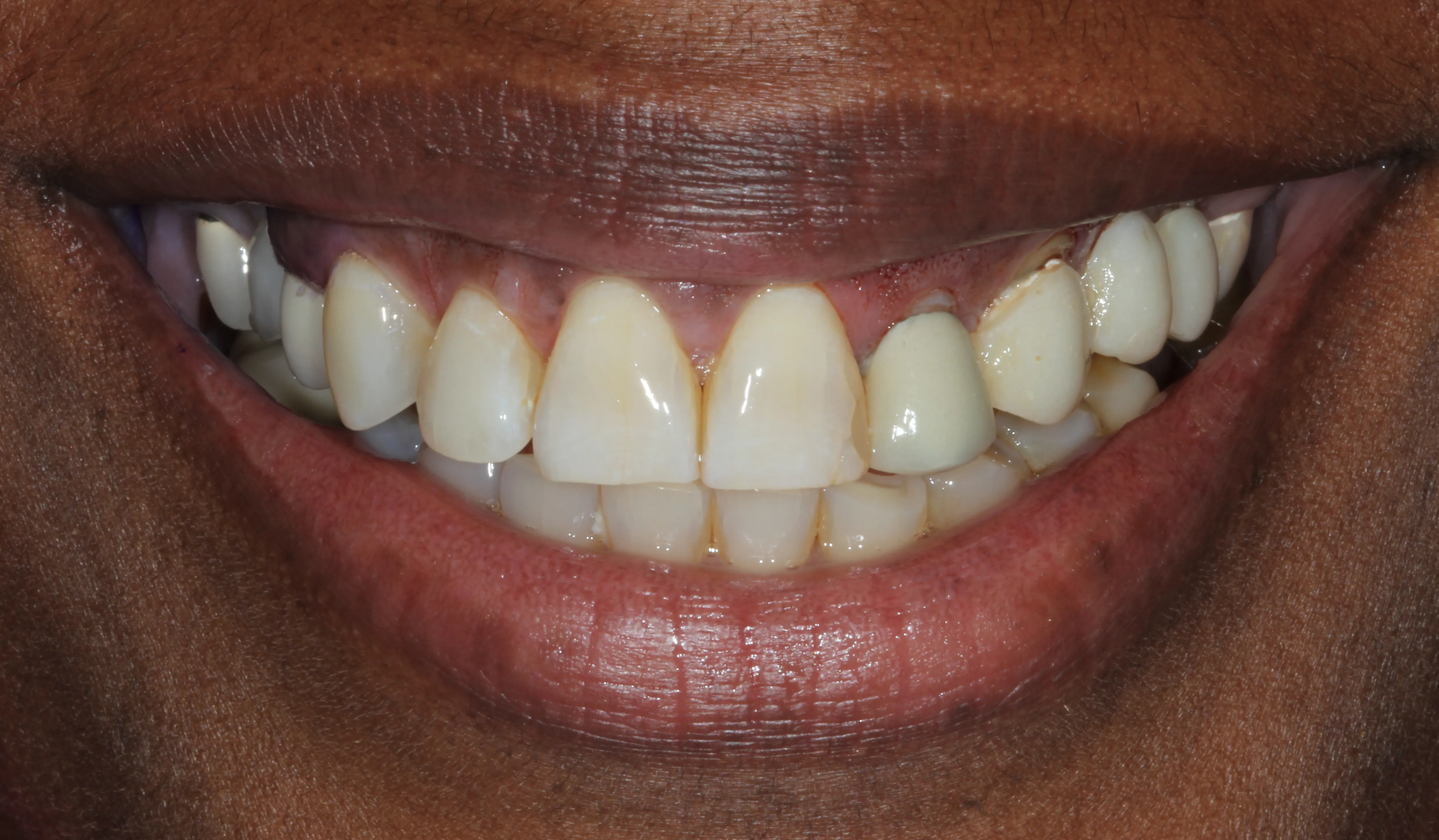 Treatment for a Gummy Smile After