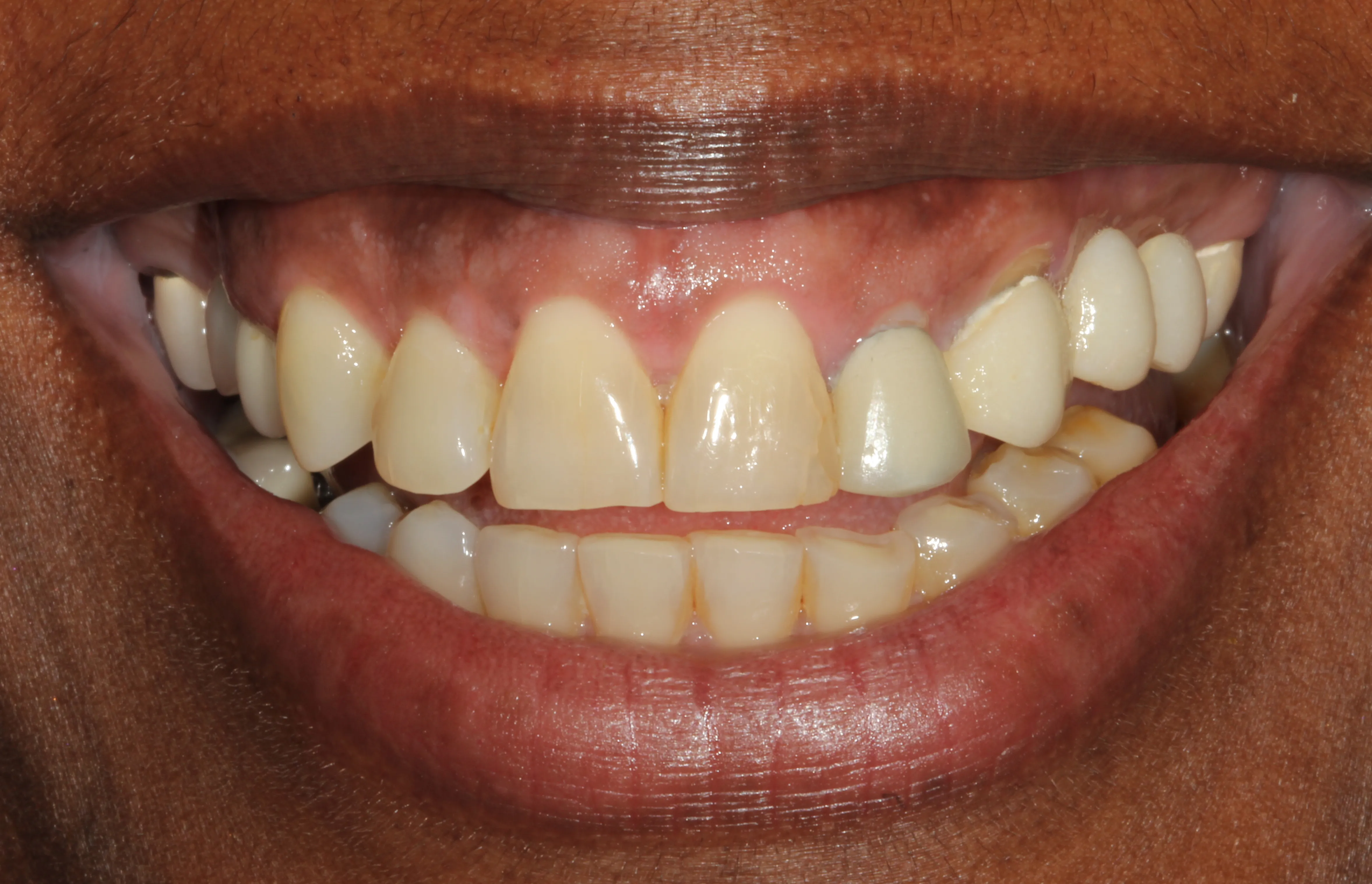 Treatment for a Gummy Smile Before