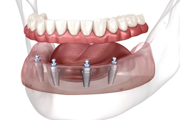 Benefits of All-On-4 Dental Implants