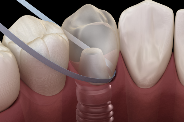 Dental Implants Cause Heart Problems