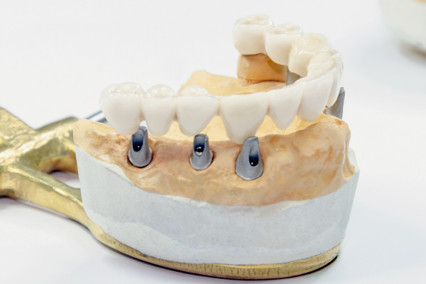 Full Mouth Reconstruction