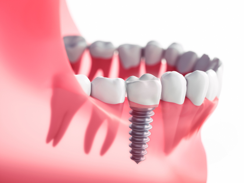 Guidelines for Getting Dental Implants for Heart Patients