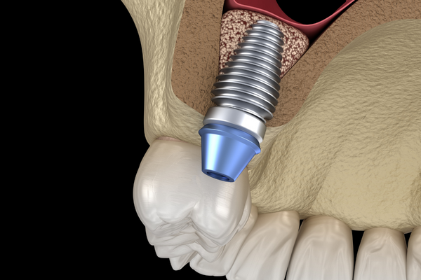 Precautions to Be Taken After Sinus Lift Augmentation