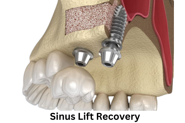 Sinus Lift Recovery