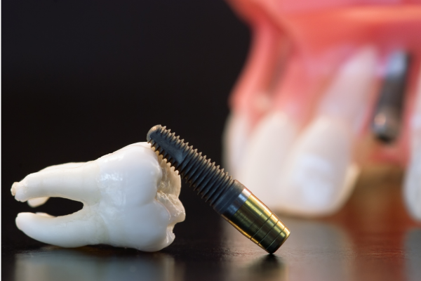 Dental Implants and Diabetes