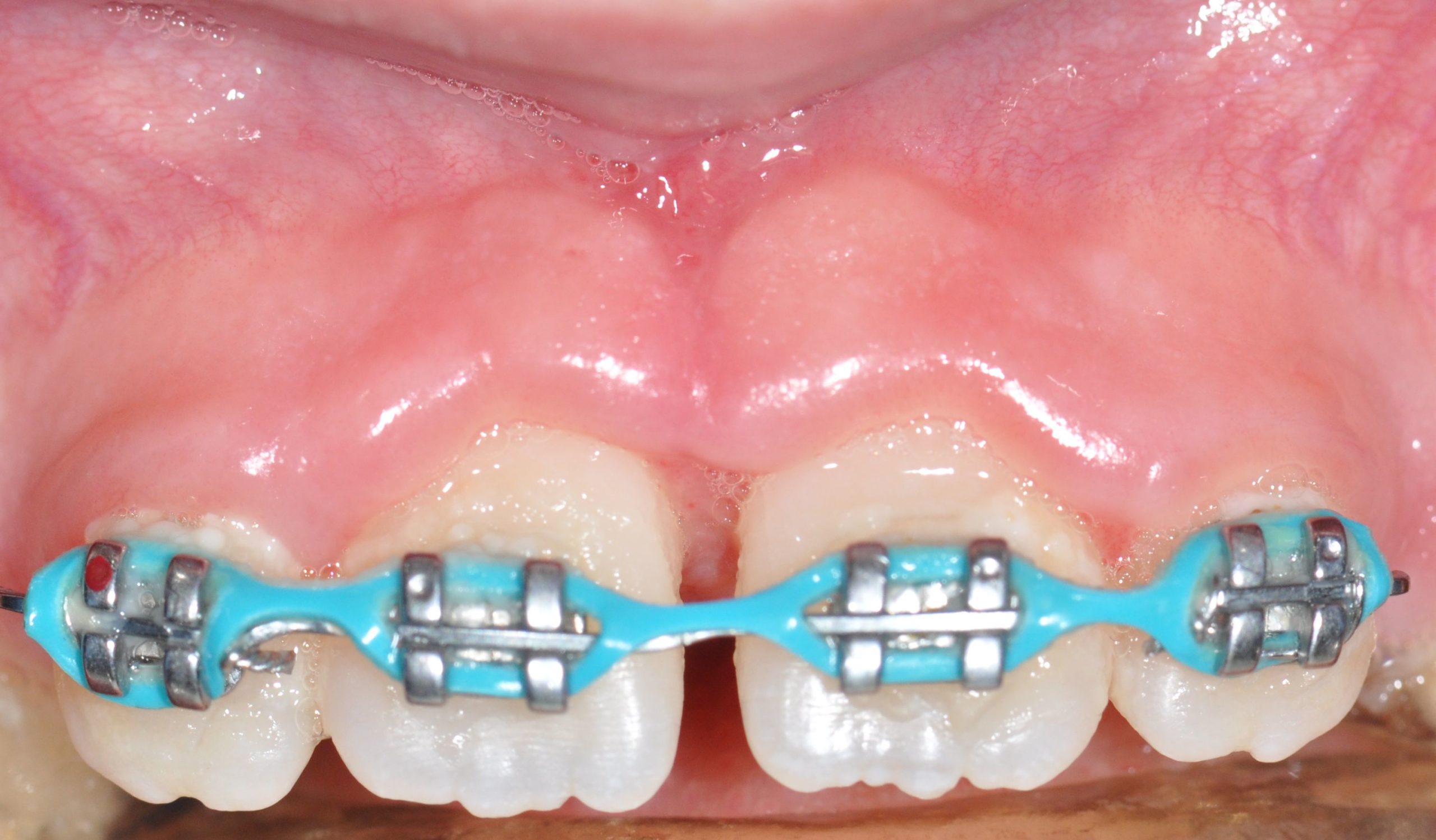 Braces