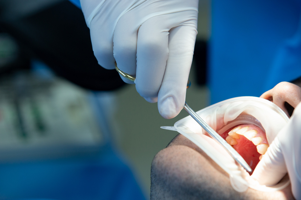 gum grafting surgery