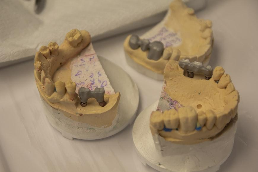 implants molar teeth