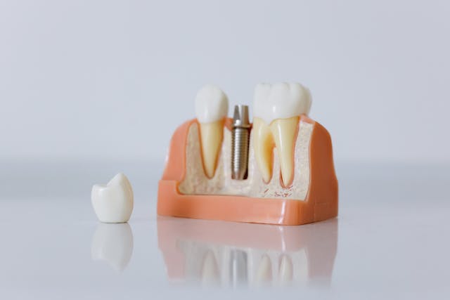 all on 6 dental implants