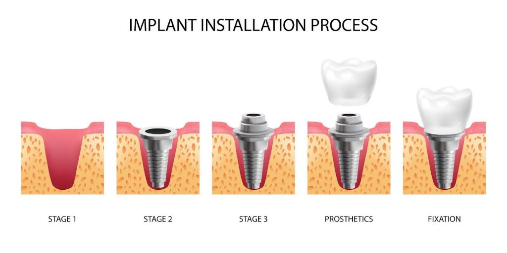 all-on-6 dental implants​
