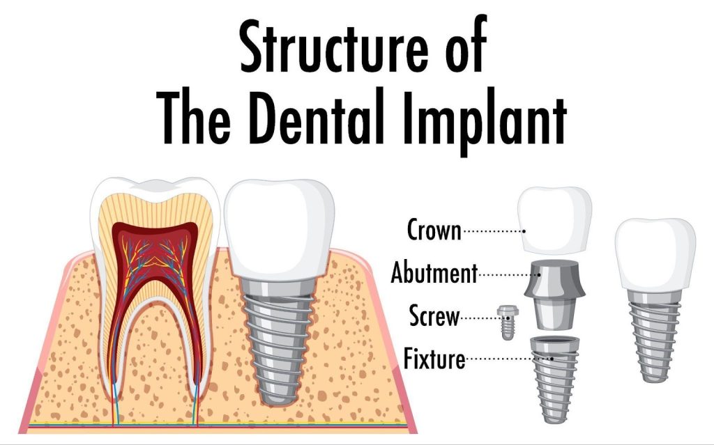 how long does a dental implant last​