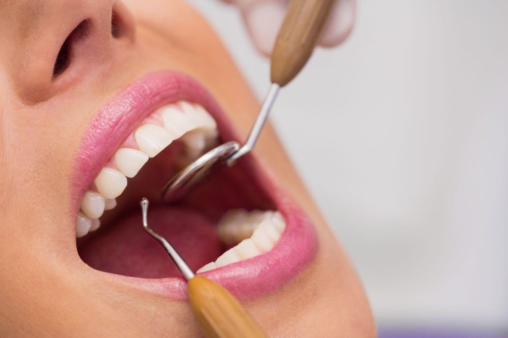 periodontal maintenance cleaning