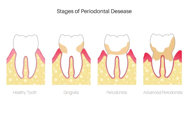 Stages of Periodontal Disease