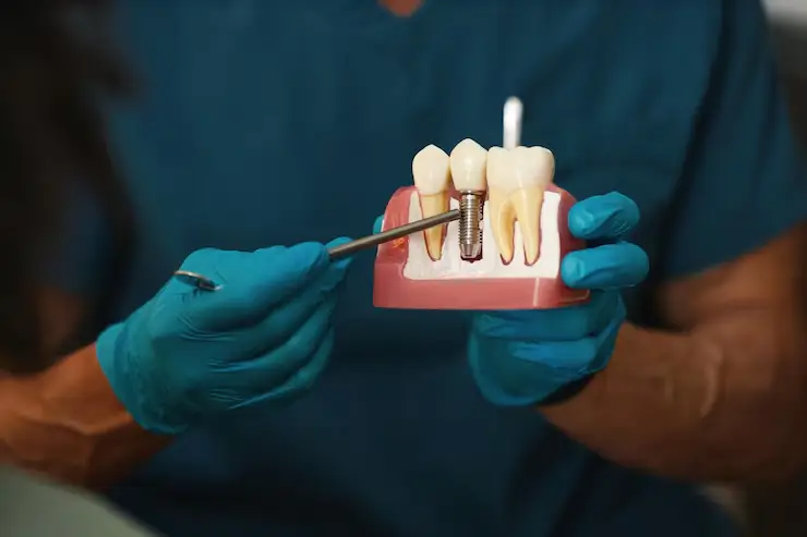 single tooth dental implant